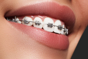 orthodontist san antonio